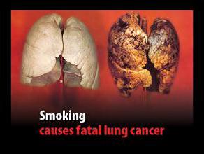 Jersey 2012 Health Effects lung - diseased organ, lung cancer, gross